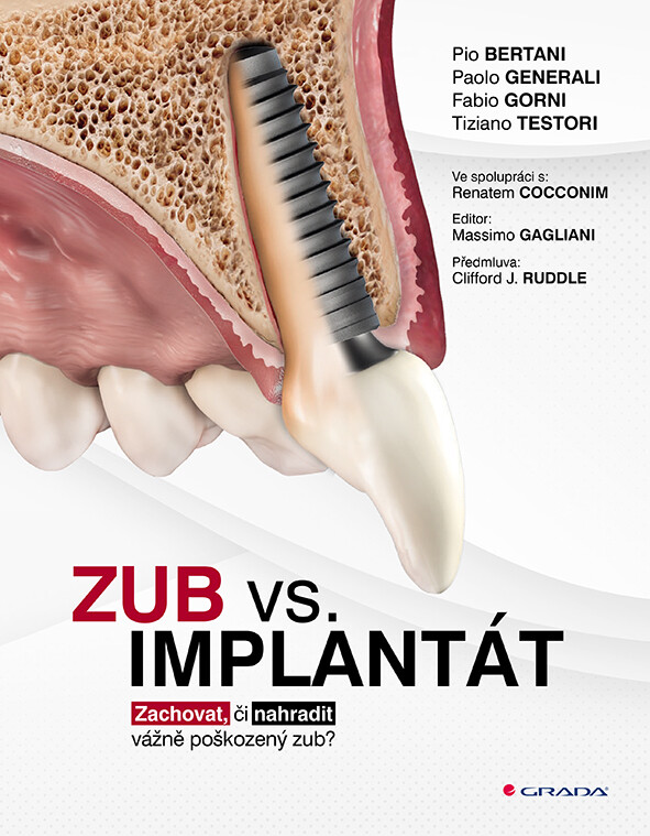 Zub vs. implantát, Bertani Pio