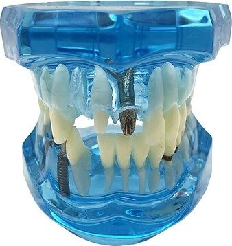 Verk 01964 Model zubných implantátov, modrý