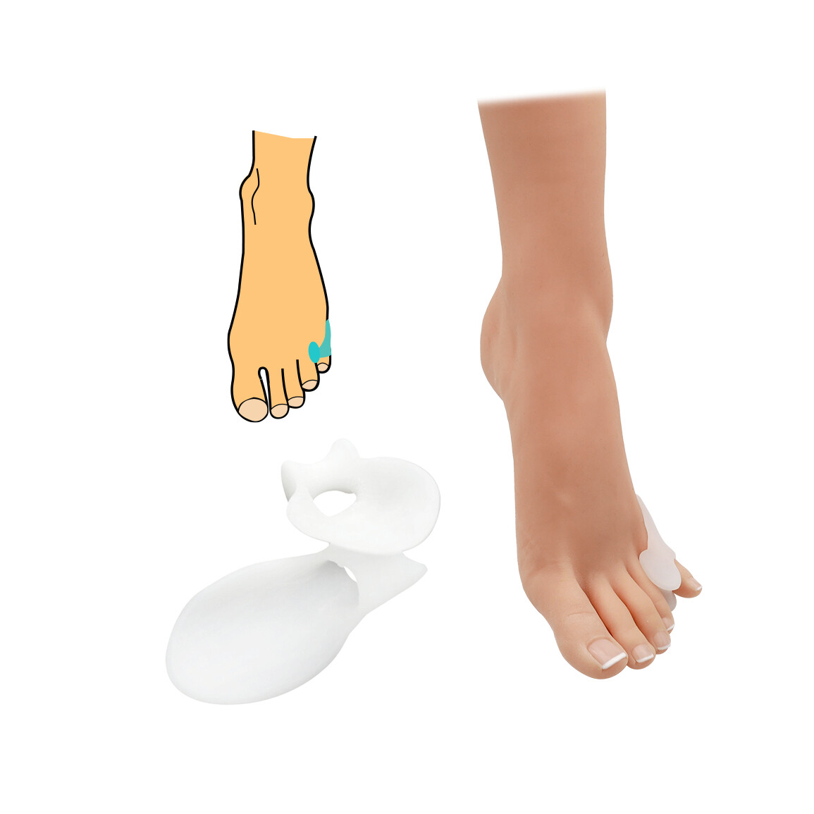 Korektor na malíček s chráničom HealMed 1 pár - biely