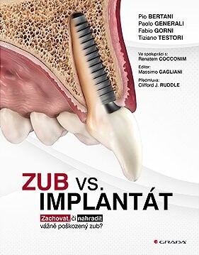 Zub vs. implantát