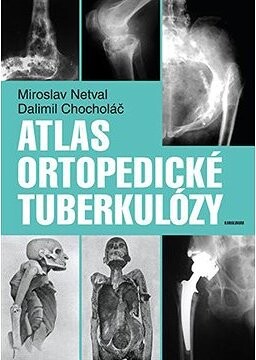 Atlas ortopedické tuberkulózy