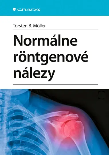 Normálne röntgenové nálezy, Moller B. Torsten